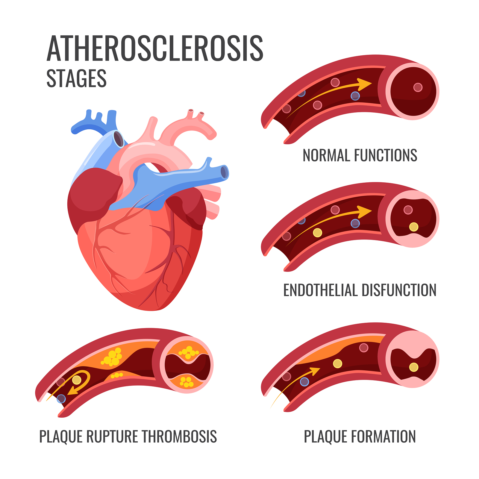 Atherosclerosis and Cardiac Physiology Forest Medical Device Testing